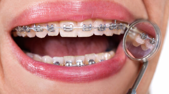 appareil orthodontique lingual